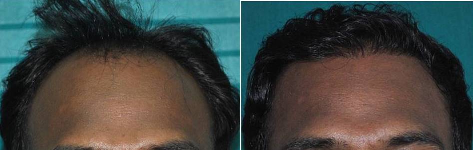Photo of hair transplant in Ernakulam result